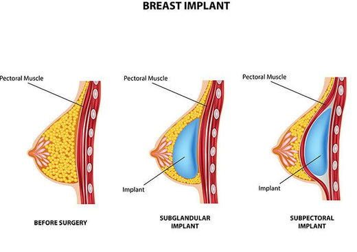 Diagram illustrating breast implants, showing three stages: "Before Surgery" with natural breast anatomy, "Subglandular Implant" with the implant placed under breast tissue, and "Subpectoral Implant" with the implant placed under the pectoral muscle.