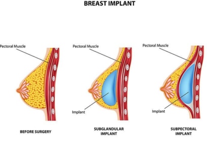 Breast implants and breastfeeding or pumping